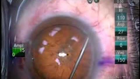 Dr Devgan showcases the benefits of the Zeiss Lumera Microscope