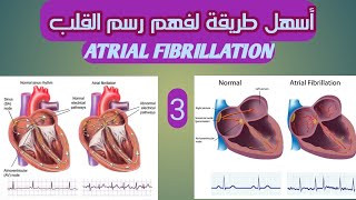 الرجفان الأذينى و أسبابة وأنواعه وكيفية التعامل معه ATRIAL FIBRILLATION , CAUSES, SIGNS,TREATMENT,AF