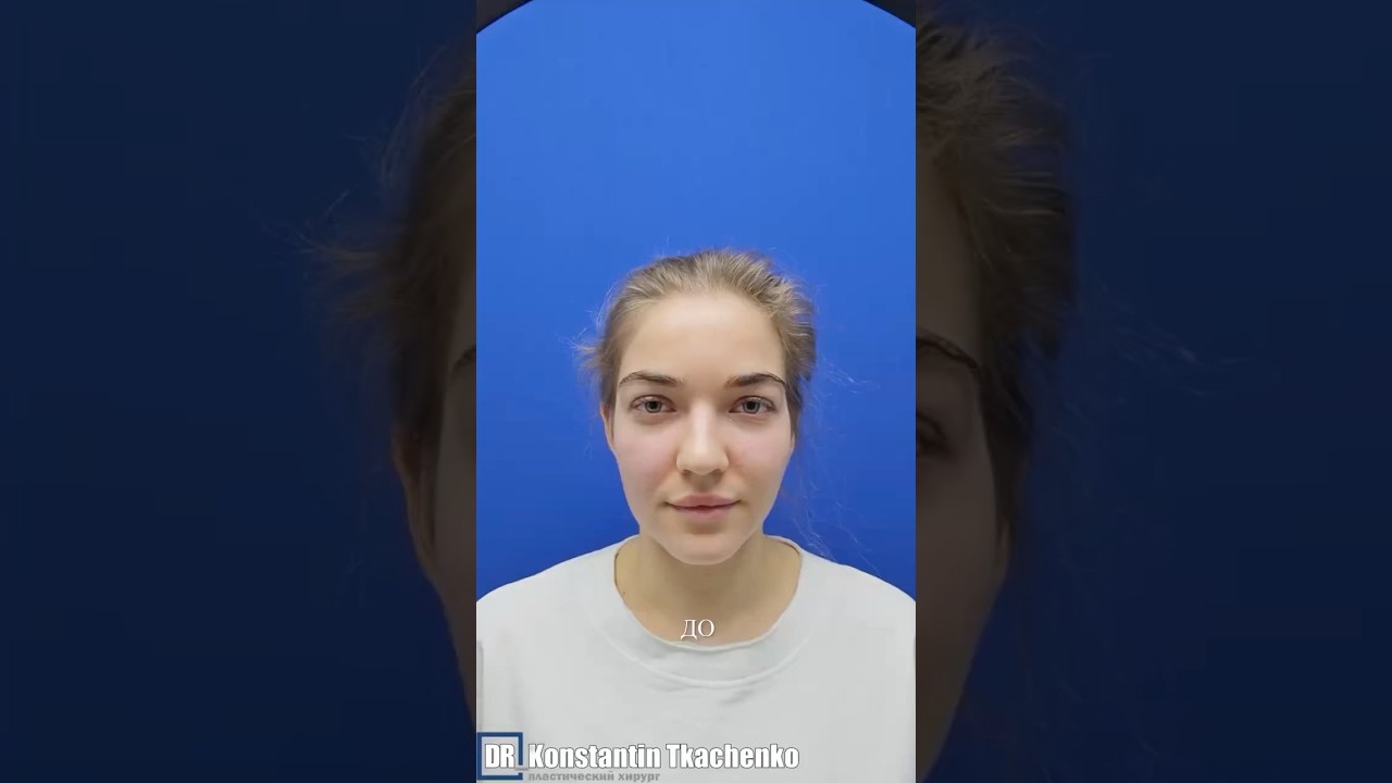 Пациентка приехала ко мне на ринопластику из Красноярска, жалобы были на форму носа. #ринопластика