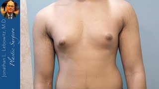 18 Y/O Gynecomastia Gland 🍳🍳 Removal Surgery, The Long Island Gynecomastia Center By Dr. Lebowitz
