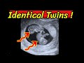 Identical twins  (Fraternal twins)