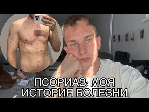 Как я лечился от ПСОРИАЗА | Моя история болезни