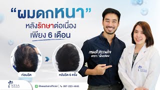 ฉีดรักษาผมร่วง ผมบาง กับ "คุณเทมส์ สรรพกิจ" ผลลัพธ์ปังขนาดนี้!!! ด้วยโปรแกรม PlacenTech