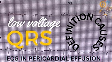 Low Voltage ECG (EKG): Criteria & Causes | ECG (EKG) in Pericardial Effusion