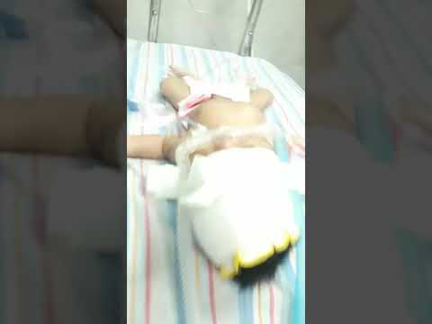 Continuous positive airway pressure (CPAP) attached to baby