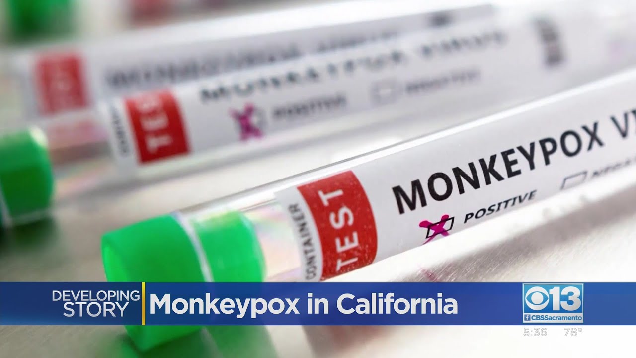 3 Confirmed Monkeypox Cases In Sacramento County