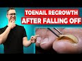 Why are my Toenails Falling Off? [Toenail Regrowth After Falling Off]