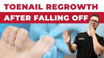 Why are my Toenails Falling Off? [Toenail Regrowth After Falling Off]