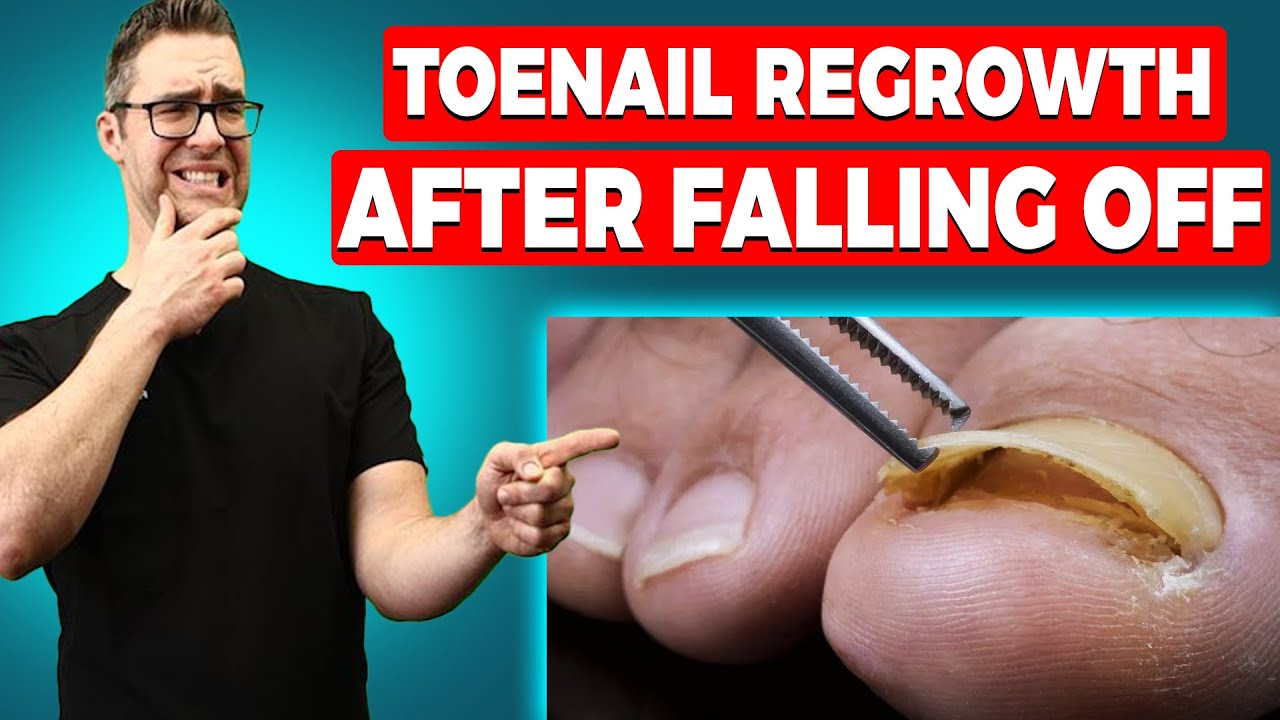 Why are my Toenails Falling Off? [Toenail Regrowth After Falling Off]