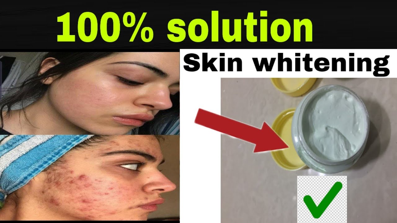 Acne pimple Remove Best cream Avocado skin whitening cream YouTube