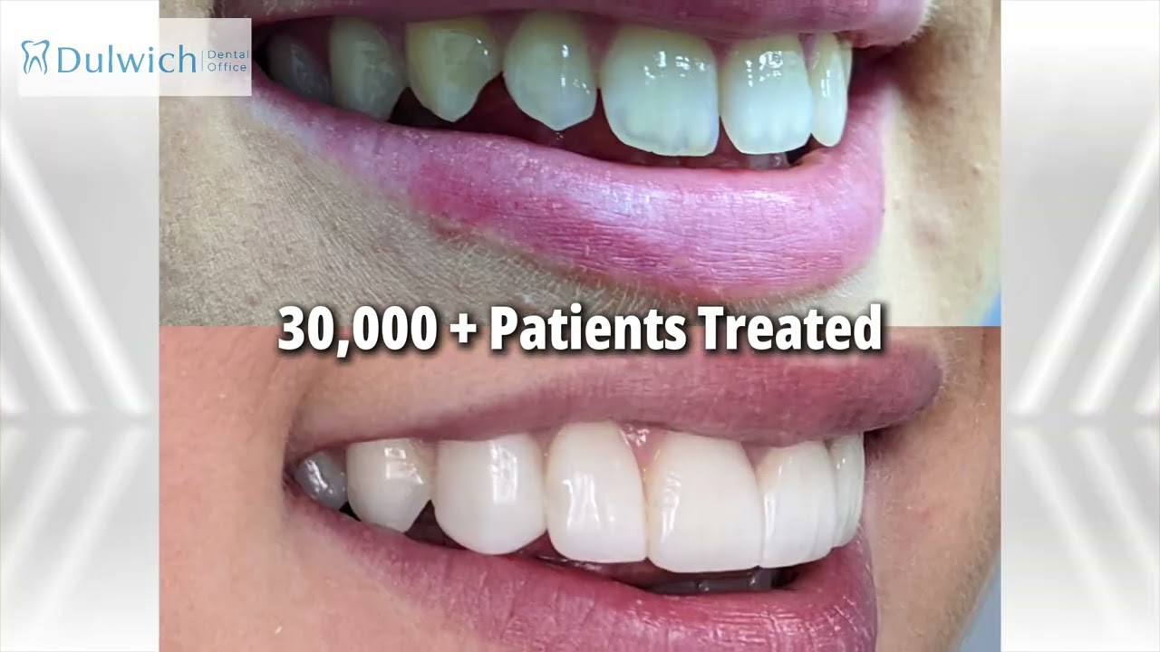 Dulwich, London Cosmetic Bonding | Number 1 Clinic | Dulwich Dental Office