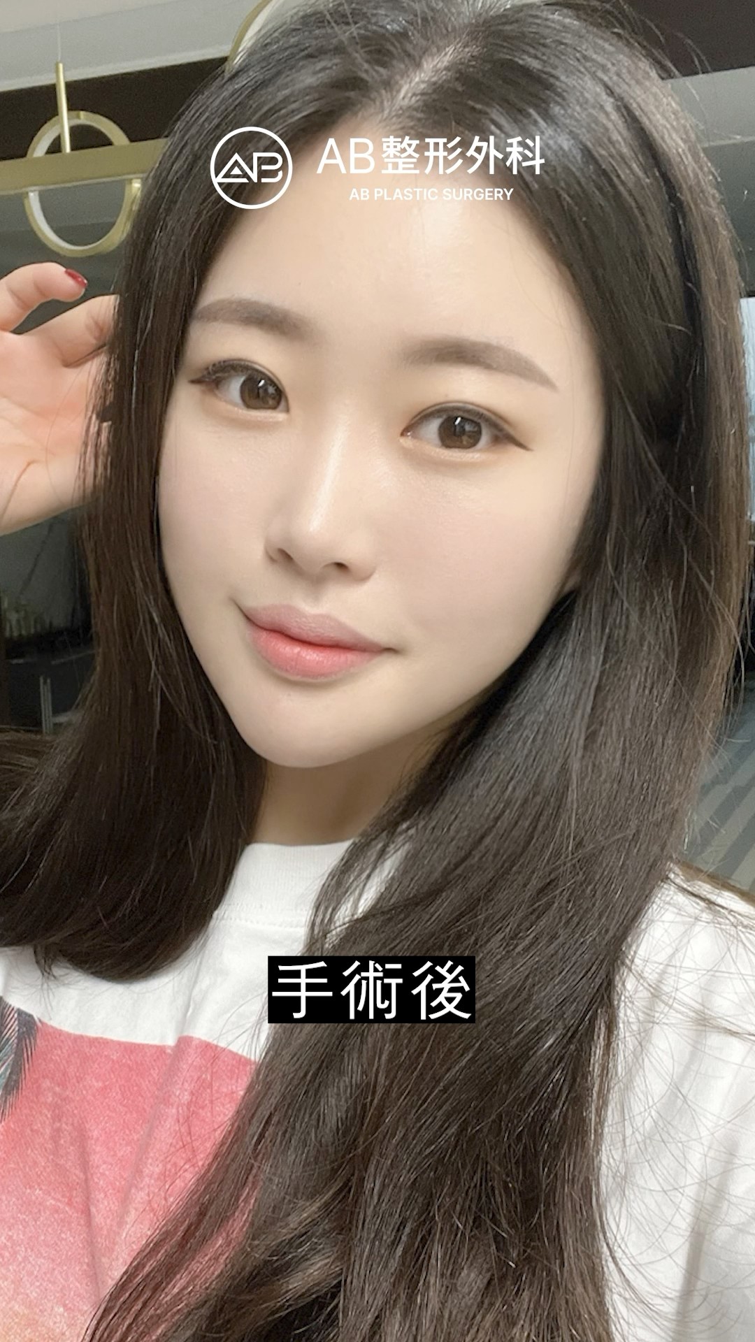 雙眼皮修復手術＋輪廓重塑，素人變女神！#shorts