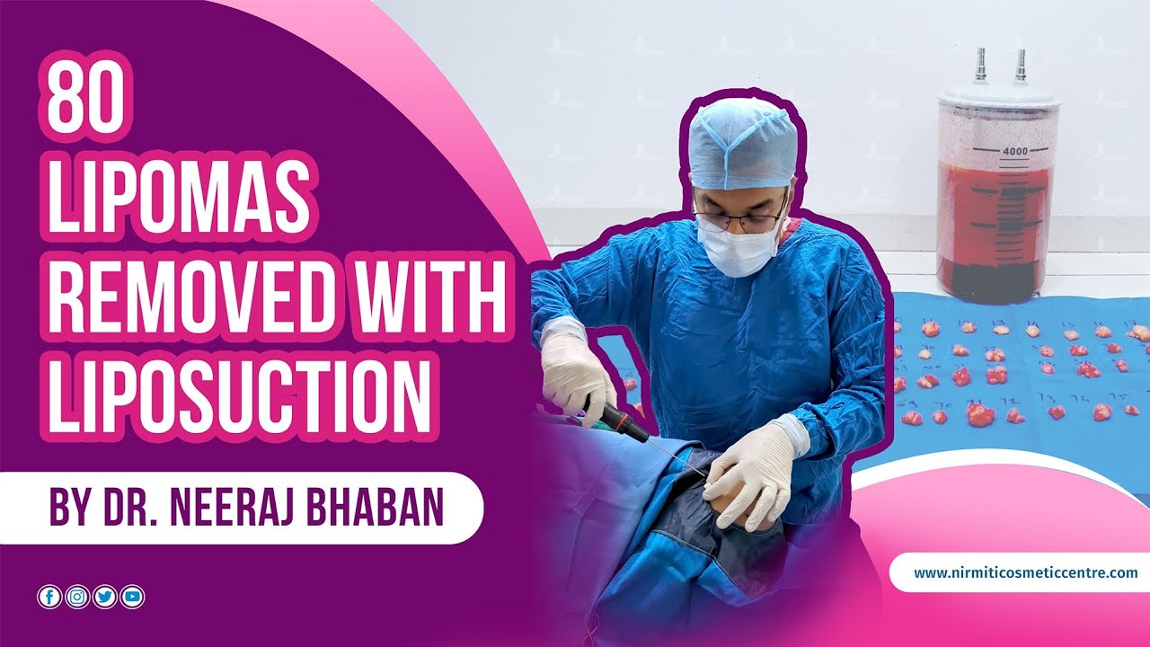 80 Lipoma Removal with Liposuction Nirmiti Plastic, Cosmetic & Laser