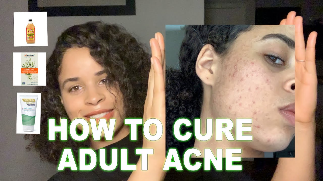HOW I CURED MY ADULT HORMONAL ACNE | Sensitive Skincare Routine 