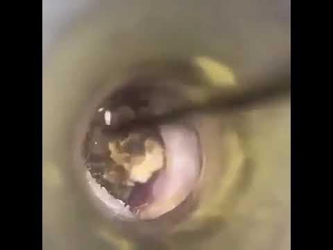 Un énorme bouchon de cérumen dans l'oreille - Vidéo Dailymotion