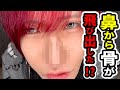【整形失敗⁉︎】鼻がもう限界です。【初投稿】