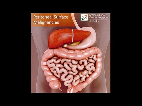 Peritoneal Cancer (Peritoneal Tumours)