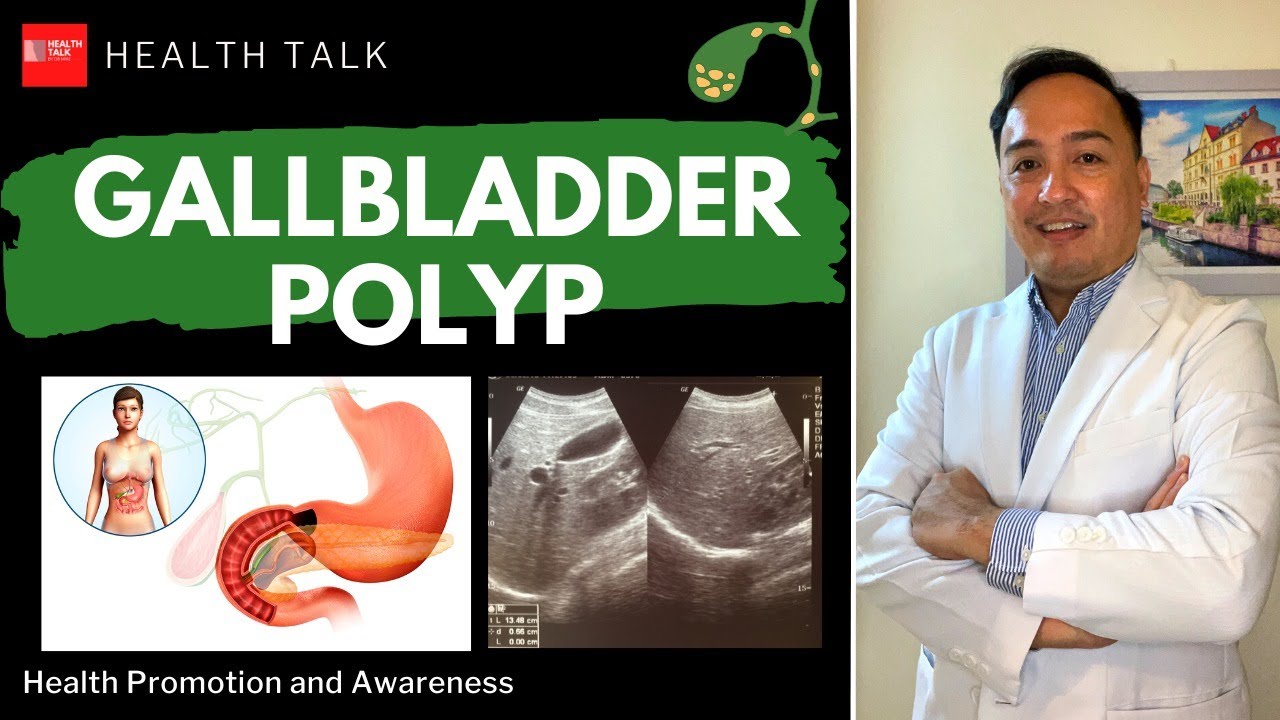 What Happens If You Have Polyps In Your Gallbladder Symptoms Causes 