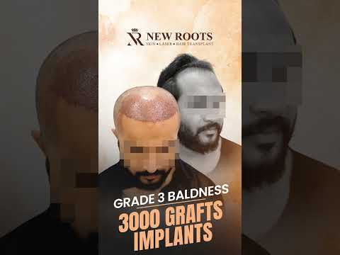 Hair Transplant in Lucknow | 3000 Grafts Cost | Grade 3 Baldness #hairtransplant #shorts