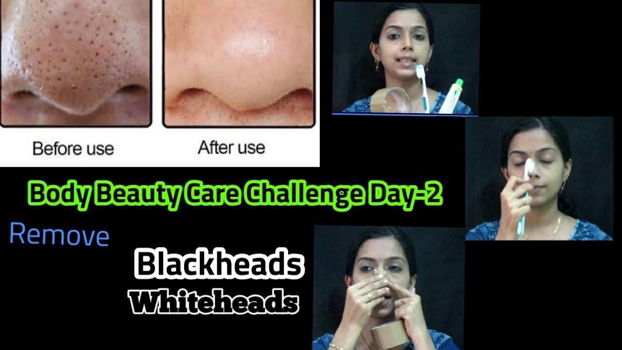 Blackheads Whiteheads Removal At Home With in 10 seconds100 Result