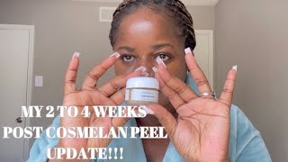 Cosmelan peel/Mask | 24 WEEKS POST APPLICATION UPDATE! Part 3 of 4
