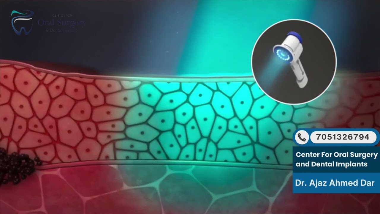 Oral Cancer screening 