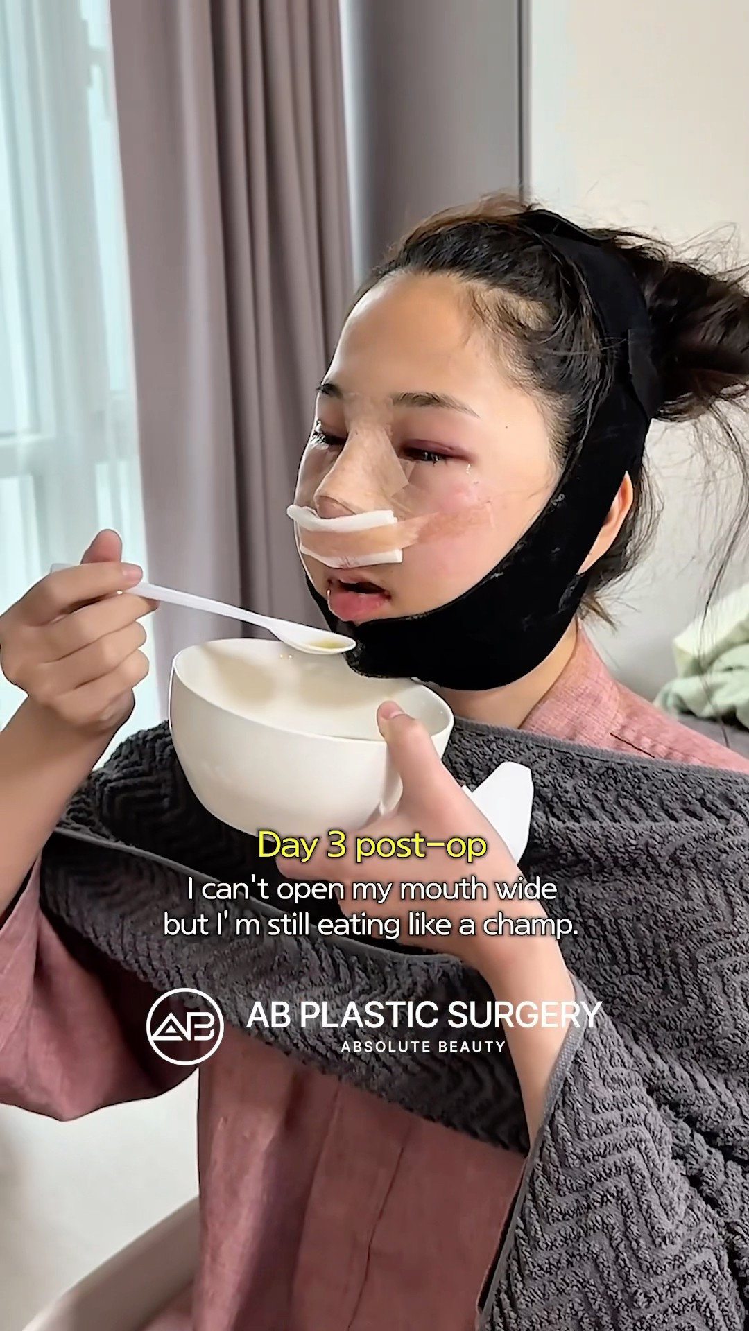 7 Days Post-Surgery in Korea, Still Swollen! #koreanplasticsurgery