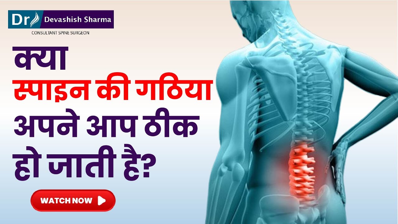 Can Spinal Arthritis Be Reversed Naturally? Spinal Arthritis Treatment In India -Dr Devashish Sharma