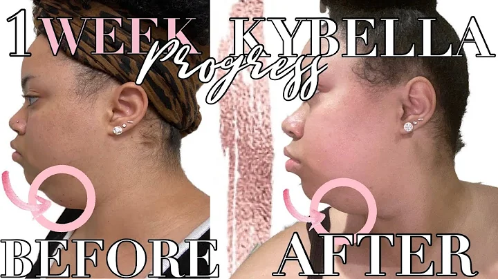 1 Week Post-Injection Update | Kybella Vlog Part 2