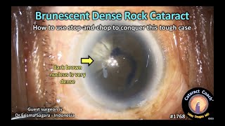 CataractCoach™1768: brunescent dense rock cataract