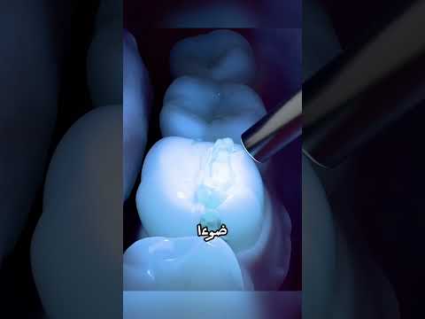 طبيب أسنان يحذر لا تسته ن بحبة الذرة غير المنفجرة