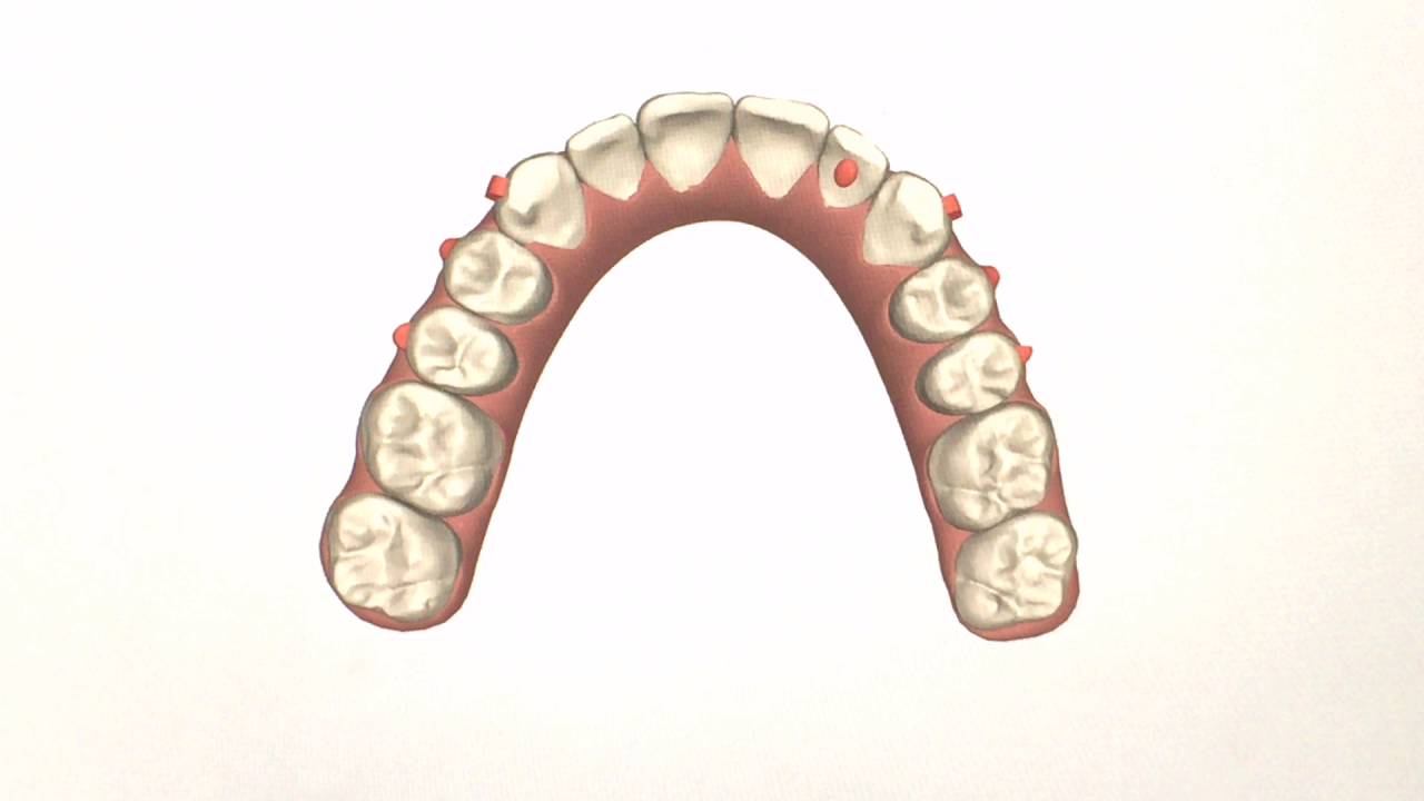 Patient 127 Invisalign movie