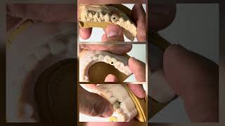 Single custom zirconia implant crowns we just completed in our