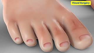 Névrome De Morton Du Pied Et Orteils - Chirurgie - Dr Simon Tournemine