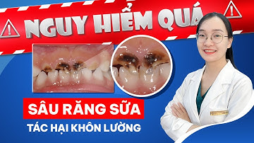 Sâu Răng Sữa - Vấn Đề Nhỏ, Hậu Quả lớn | Nam Bùi Vinalign