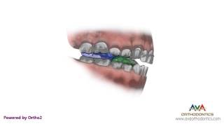 Orthodontic Treatment for Overjet (Overbite) - Twin Block Appliance