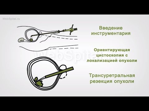 Лечение рака мочевого пузыря - трансуретральная резекция или ТУР мочевого пузыря