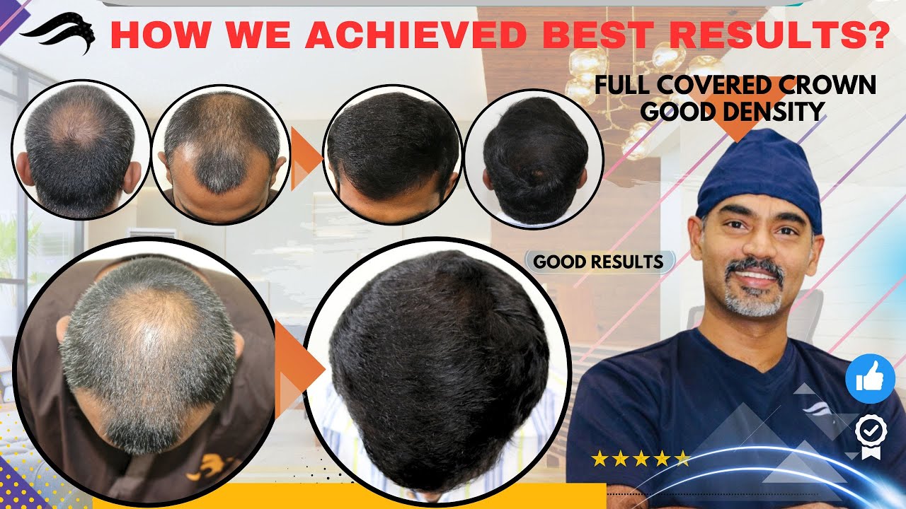 Hair Transplant In Chennai Best Cost Results Clinic & Surgeon Of Hair