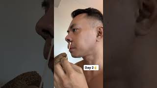 My rhinoplasty journey #nosejob #aesthetic #rhinoplasty My rhinoplasty journey #nosejob #aesthetic #rhinoplasty
