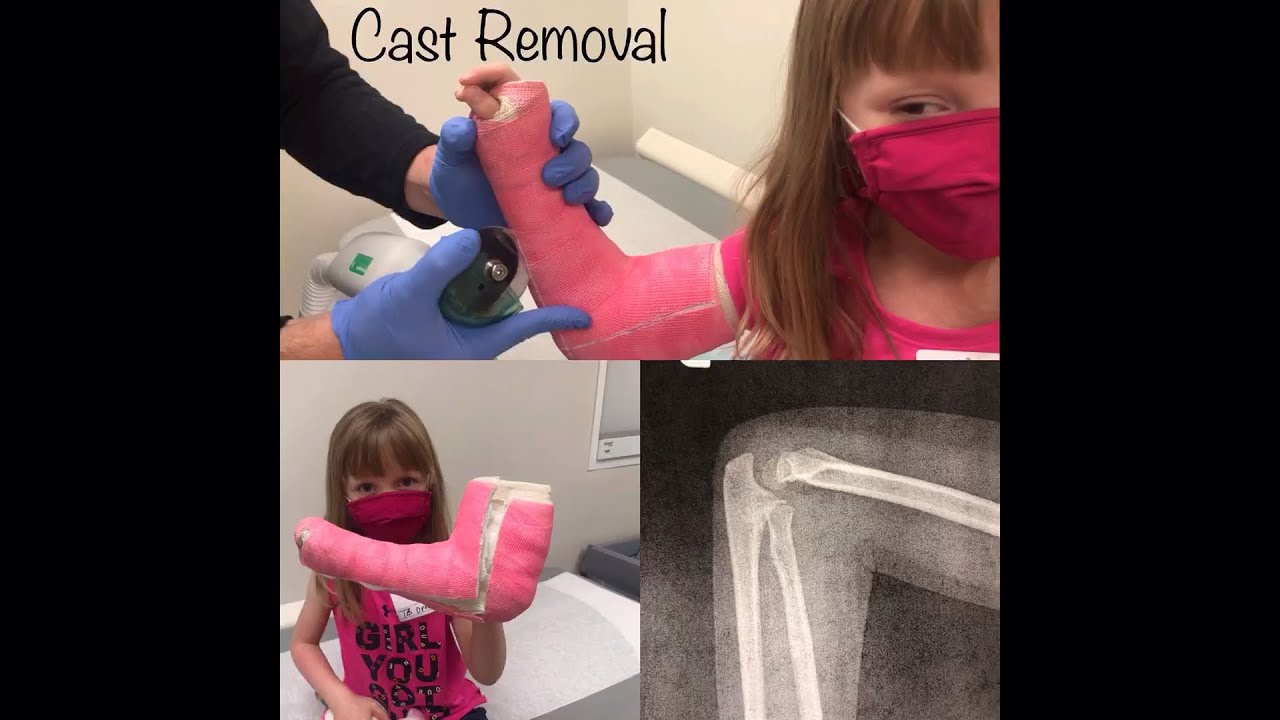 Long Arm Cast Removal 5yo Gets Cast Removed Hospital VLOG VLOGMAS