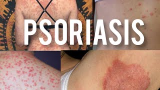 Psoriasis | types | causes | factors | explained in tamil | Homeopathy for Health | health patho