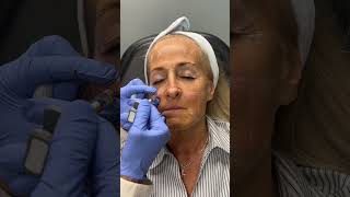 Subtle Lift, No Surgery 💖 Cheek Augmentation Deal #cheekfiller #dermalfillers #nonsurgicallift