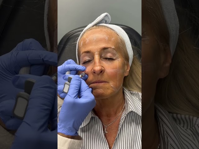 Subtle Lift, No Surgery 💖 Cheek Augmentation Deal #cheekfiller #dermalfillers #nonsurgicallift