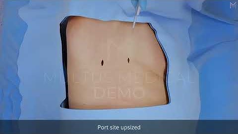 Visualizing Severe Rib Trauma | Rib ORIF After Motor Vehicle Collision