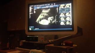 Pregnancy ultrasound revealing gender of Baby Peach
