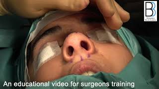 Wide Bulbous Tip-16: Nose Reshaping Bizrah Rhinoplasty