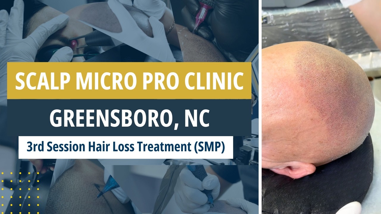 3rd Session Hair Loss Treatment (SMP) — Scalp Micro Pro Clinic