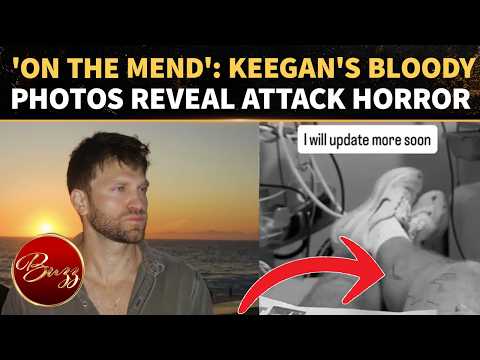 SHOCKING! Keegan Allen Shares More BLOODY Photos After HORRIFIC Gunpoint Robbery, Attackers At Large