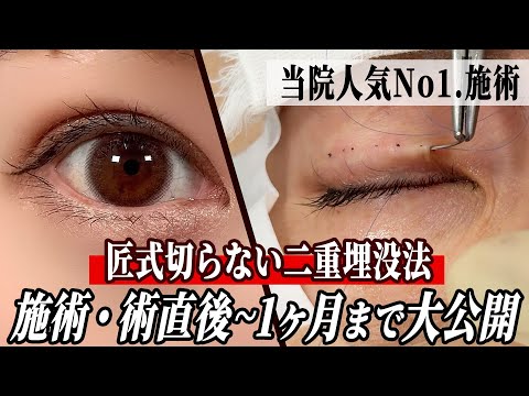 【施術動画】超人気施術・匠式切らない二重埋没の全貌を大公開！直後〜1ヶ月後の目元もお見せします。
