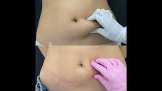 Коррекция Фигуры Ultraformer Lll